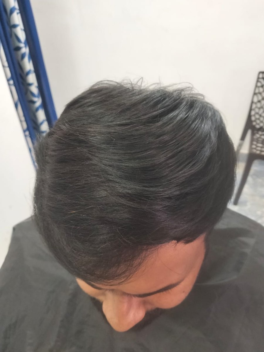 The same head from above after fitting: the bare patch is completely covered and the new hair is blended into his own.