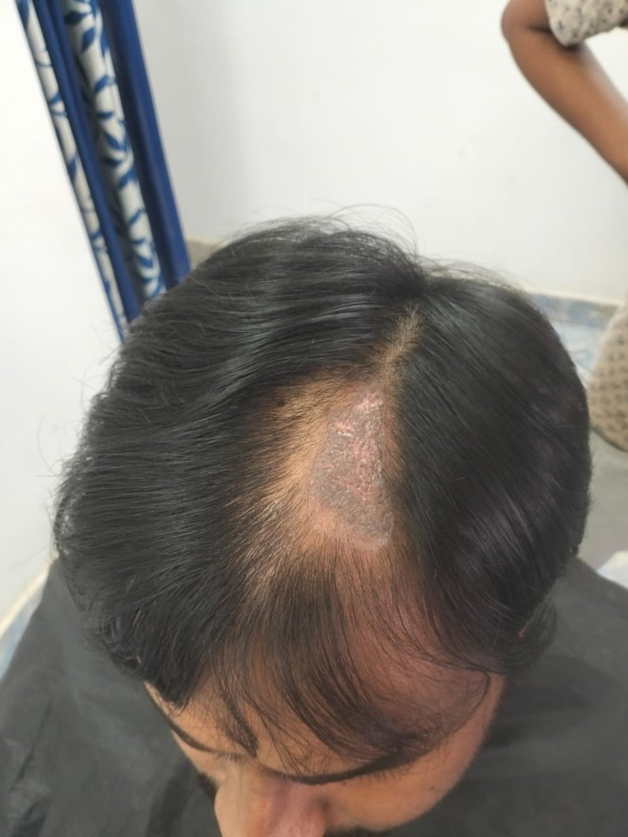 Top-down view of a man's head before hair fixing: a bare, discoloured patch of scalp at the front of the crown, with his own hair parted around it.