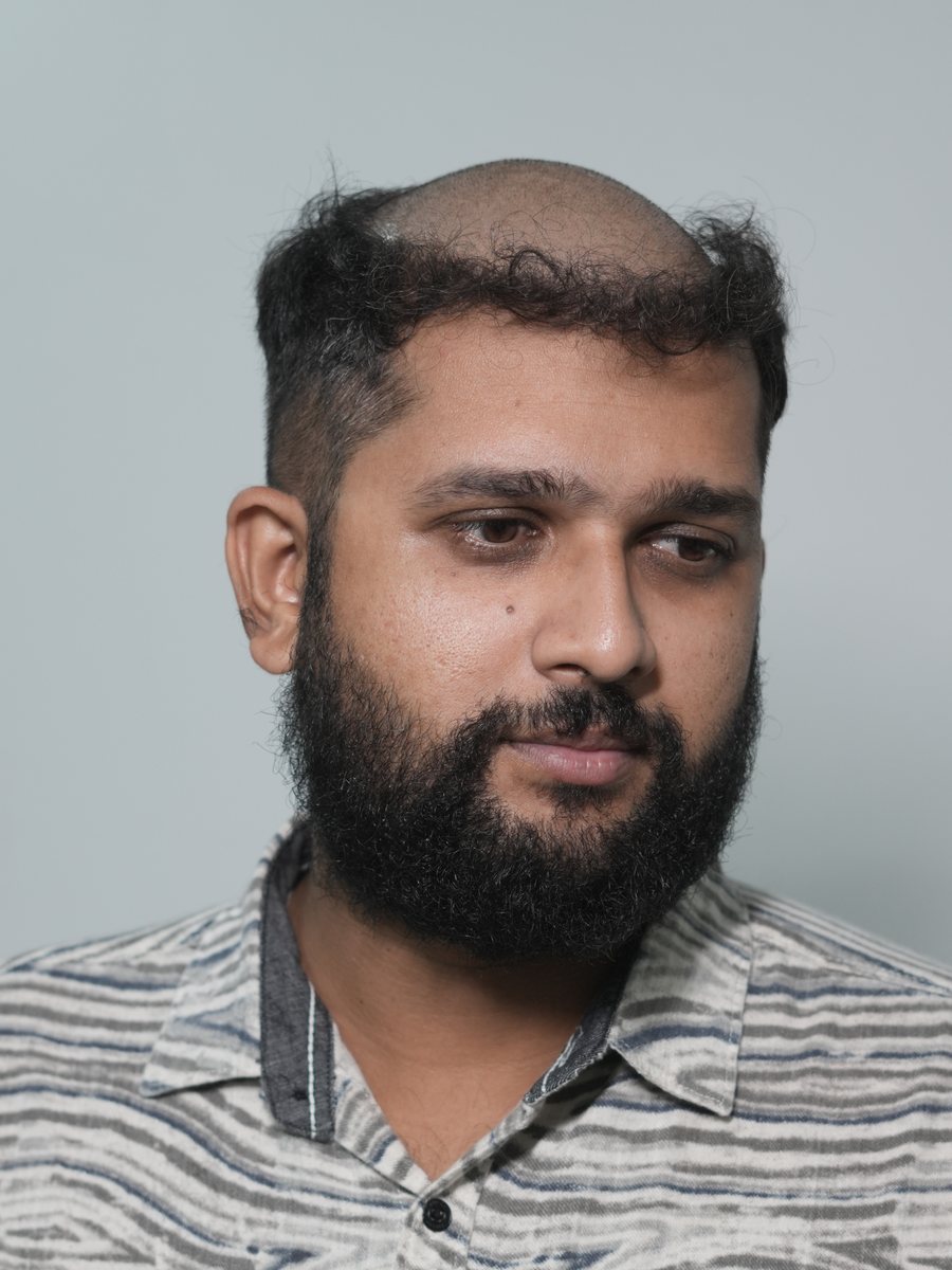 A man before hair fixing at Relookz: bald across the crown, with a thin fringe of hair remaining at the front and hair at the sides.
